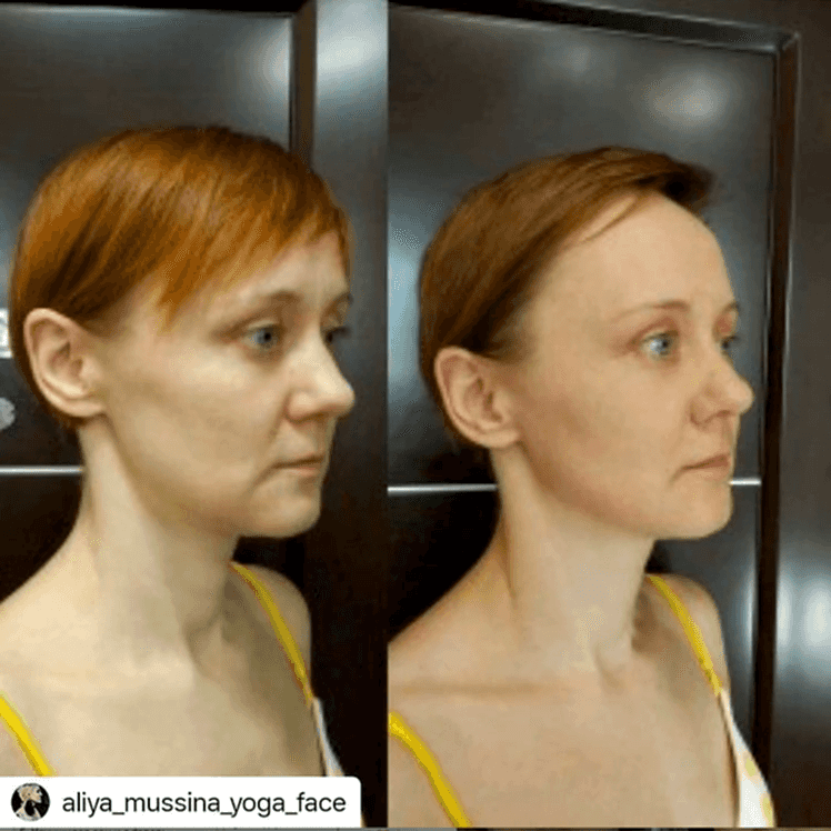 омоложение лица