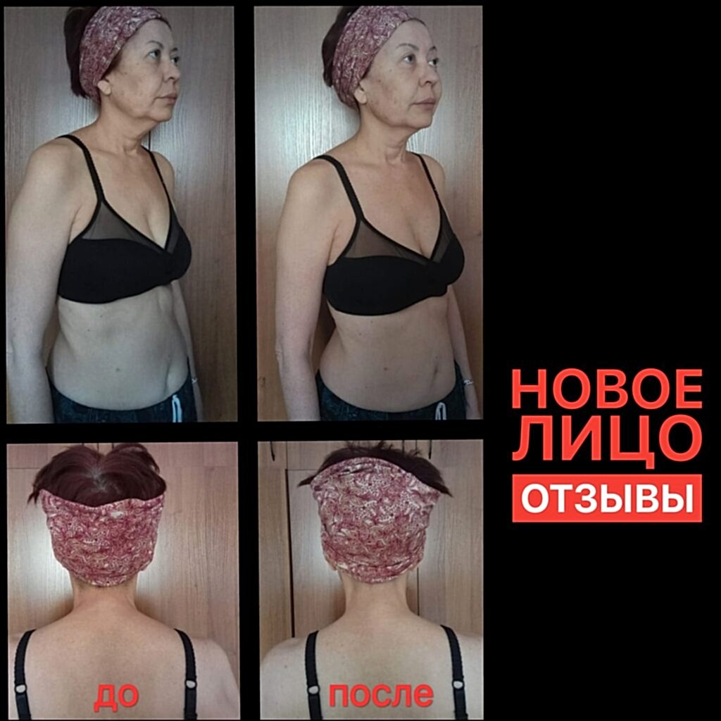 омоложение лица