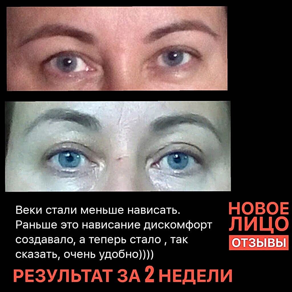 омоложение лица