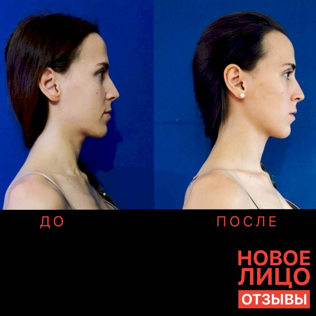 омоложение лица