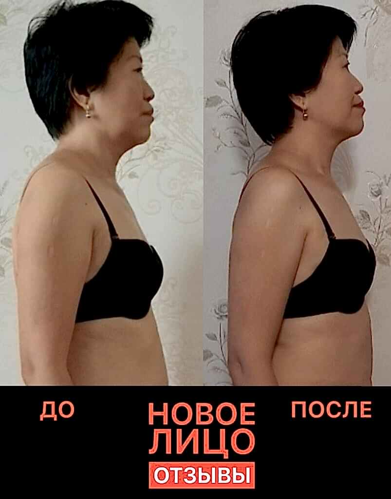 омоложение лица