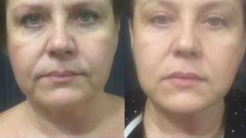 новое лицо алматы естественное омоложение отзывы