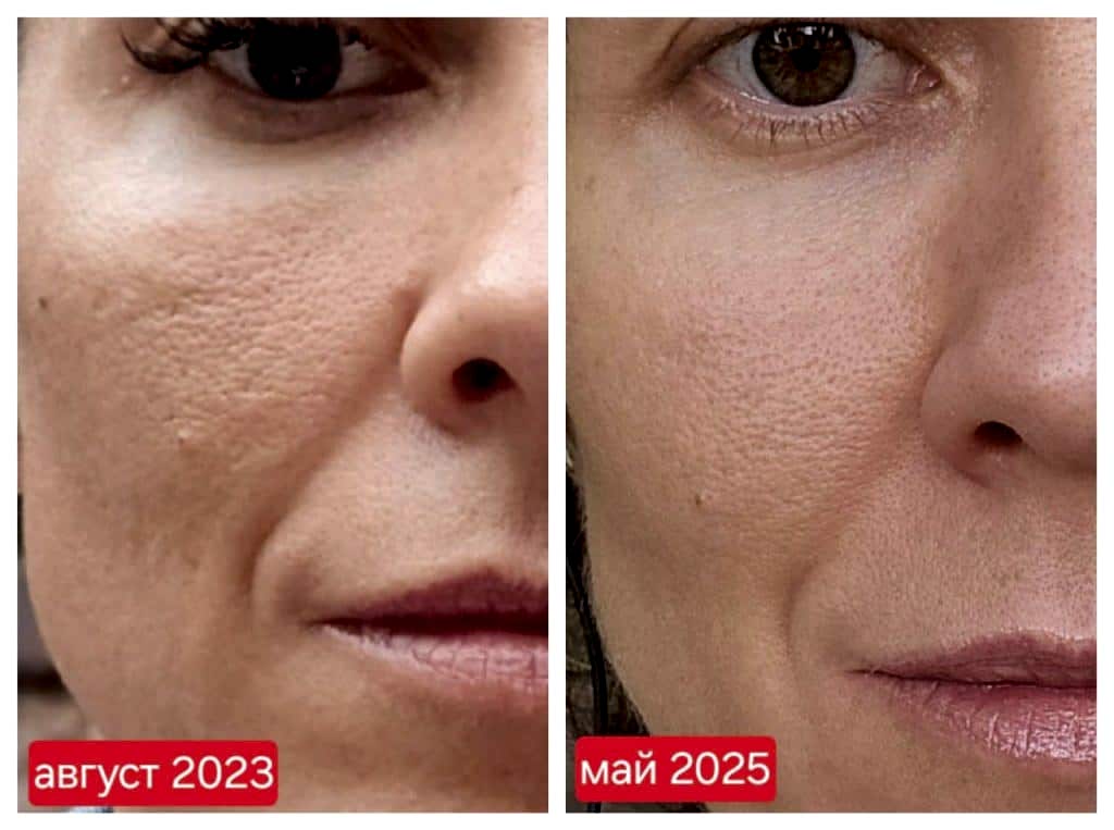 клуб новое лицо естественное омоложение алия мусина