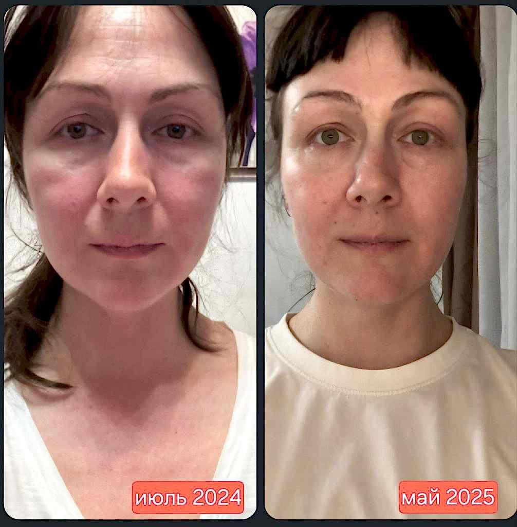 клуб новое лицо естественное омоложение алия мусина