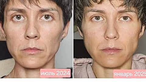 клуб новое лицо естественное омоложение алия мусина