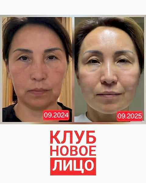 клуб новое лицо естественное омоложение